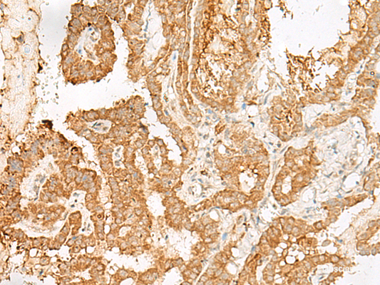 Immunohistochemistry of paraffin-embedded Human thyroid cancer tissue  using ADGRF1 Polyclonal Antibody at dilution of 1:25(×200)