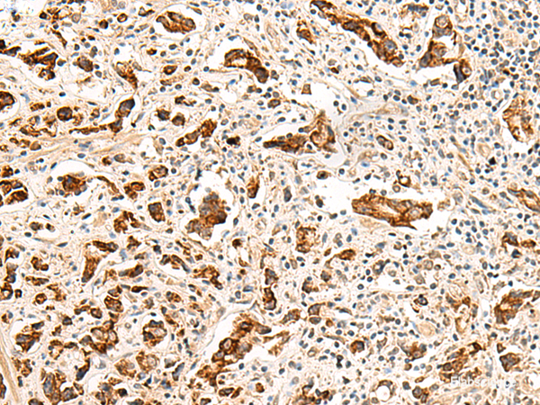 Immunohistochemistry of paraffin-embedded Human prost at e cancer tissue  using GPR160 Polyclonal Antibody at dilution of 1:35(×200)