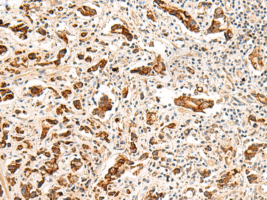 Immunohistochemistry of paraffin-embedded Human prost at e cancer tissue  using GPR160 Polyclonal Antibody at dilution of 1:35(×200)