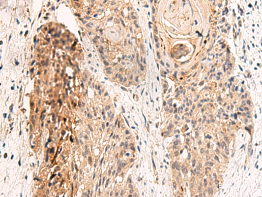 Immunohistochemistry of paraffin-embedded Human esophagus cancer tissue  using GPR152 Polyclonal Antibody at dilution of 1:45(×200)