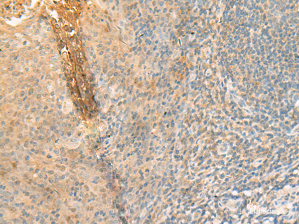 Immunohistochemistry of paraffin-embedded Human tonsil tissue  using GPT2 Polyclonal Antibody at dilution of 1:70(×200)
