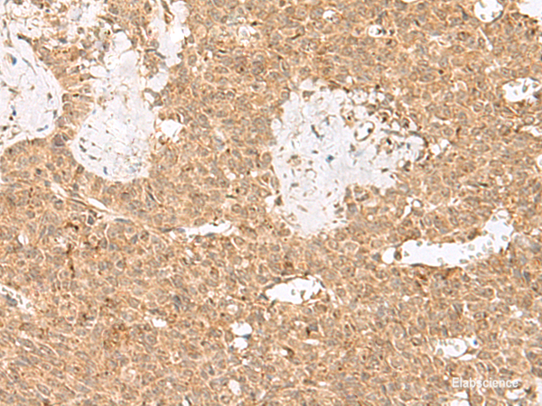 Immunohistochemistry of paraffin-embedded Human ovarian cancer tissue  using LGALSL Polyclonal Antibody at dilution of 1:25(×200)