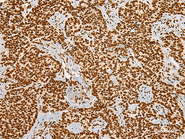 Immunohistochemistry of paraffin-embedded Human ovarian cancer tissue  using HABP4 Polyclonal Antibody at dilution of 1:55(×200)