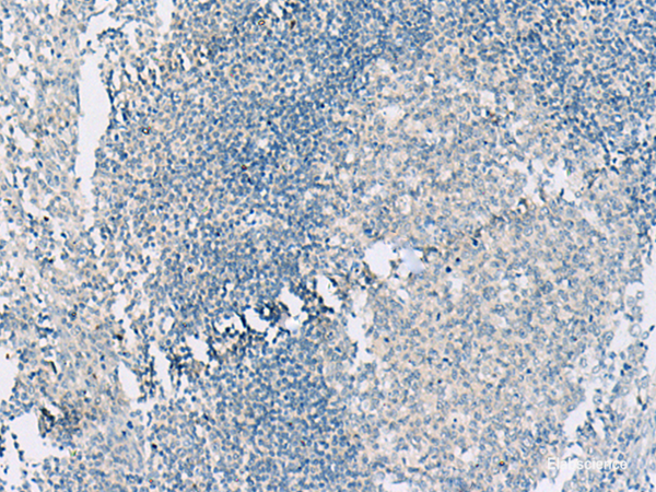 Immunohistochemistry of paraffin-embedded Human tonsil tissue  using HASPIN Polyclonal Antibody at dilution of 1:55(×200)