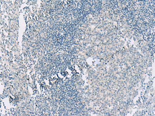 Immunohistochemistry of paraffin-embedded Human tonsil tissue  using HASPIN Polyclonal Antibody at dilution of 1:55(×200)