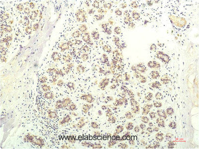 Immunohistochemistry of paraffin-embedded Human breast carcinoma tissue using STAT1 Monoclonal Antibody at dilution of 1:200.