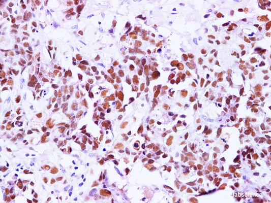 Immunohistochemistry of paraffin-embedded Human breast cancer using BRCA1 Polyclonal Antibody at dilution of 1:100