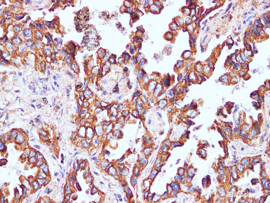 Immunohistochemistry of paraffin-embedded Human lung cancer using CK-8 Polyclonal Antibody at dilution of 1:100