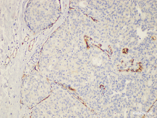 Immunohistochemistry of paraffin-embedded Human breast cancer using ENG Ployclonal Antibody at dilution of 1:200.