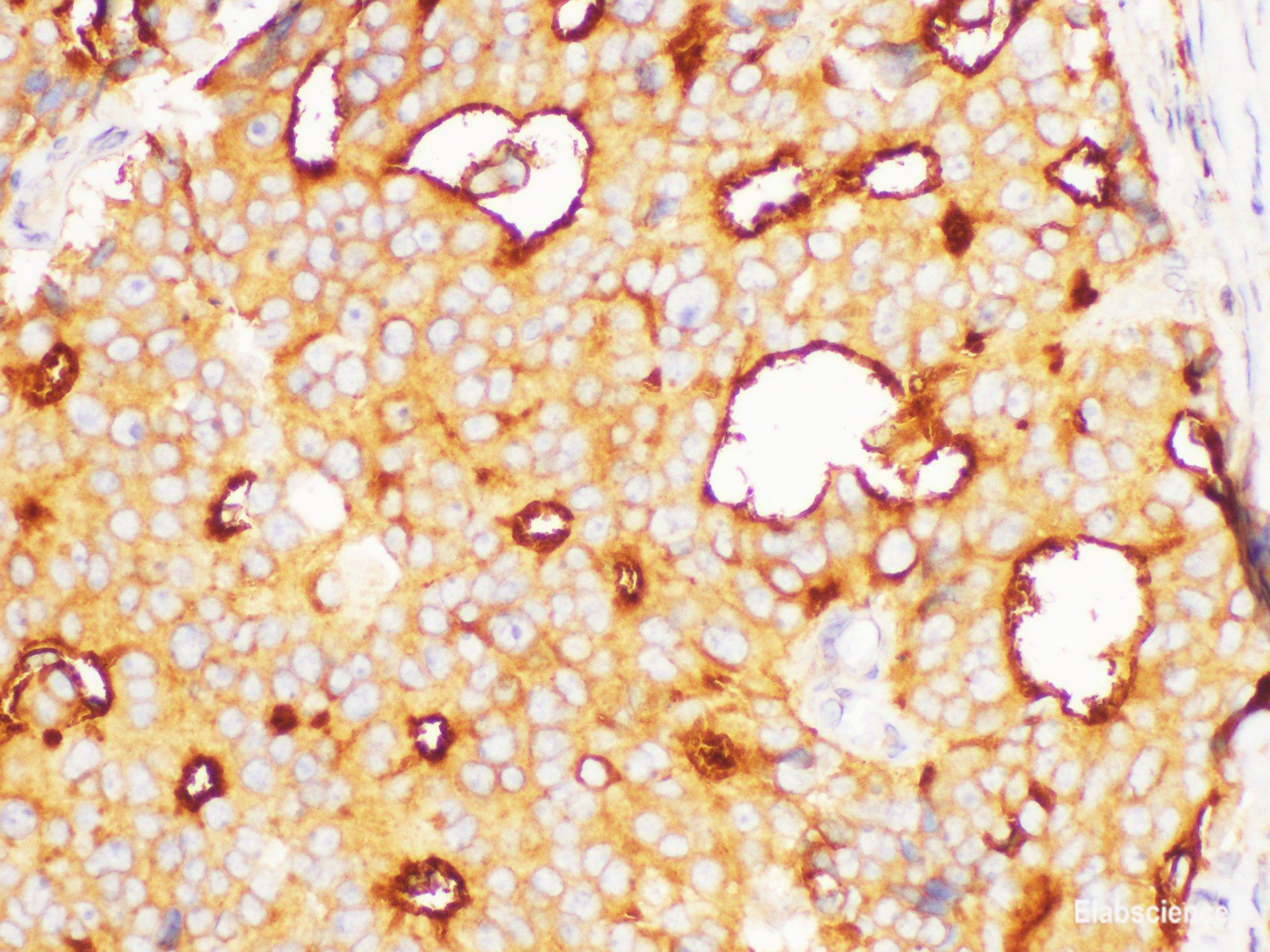 Immunohistochemistry of paraffin-embedded Human prostate cancer using FOLH1 Polycloanl Antibody at dilution of 1:200
