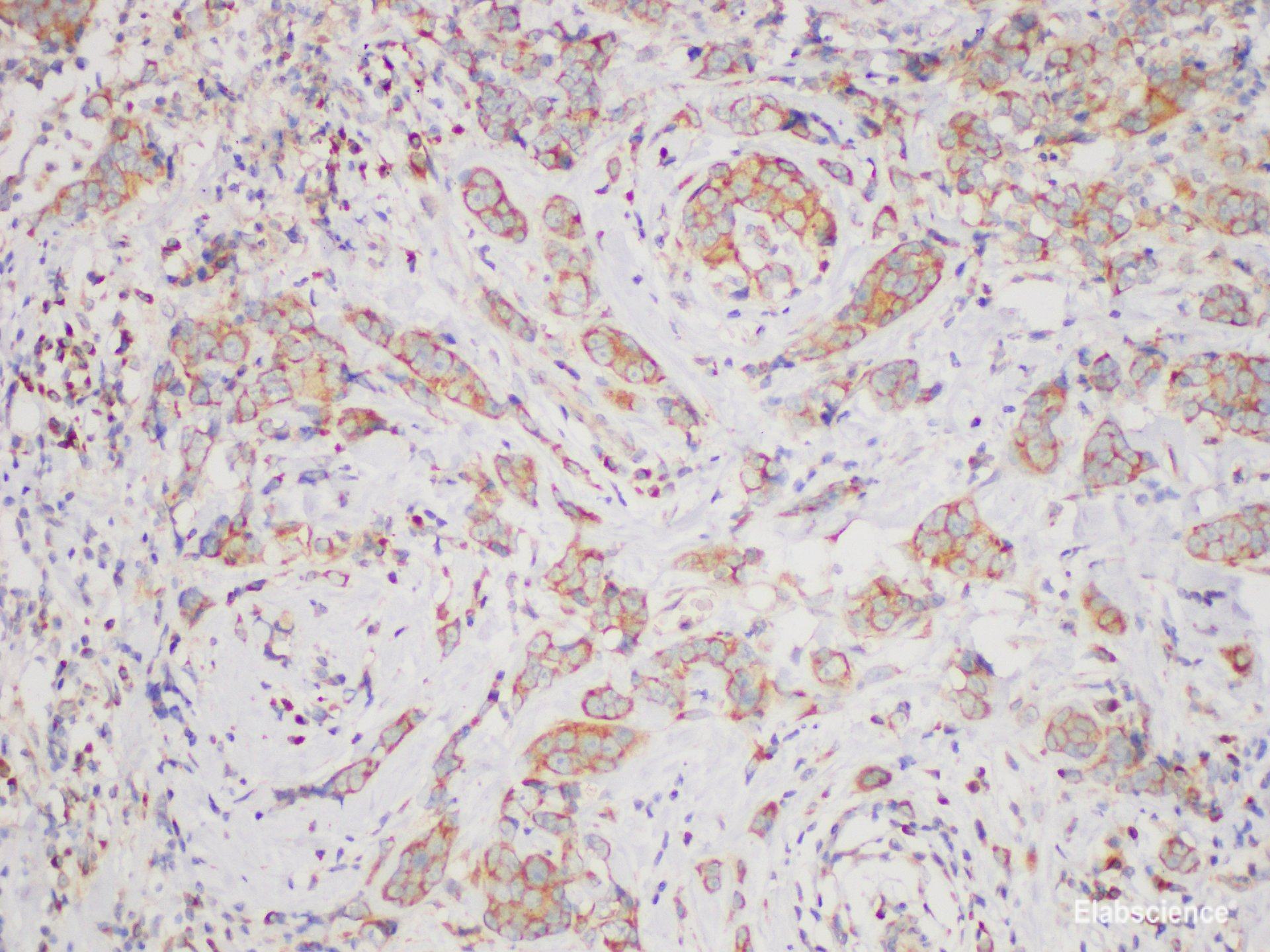 Immunohistochemistry of paraffin-embedded Human breast cancer using BCR Polycloanl Antibody at dilution of 1:200