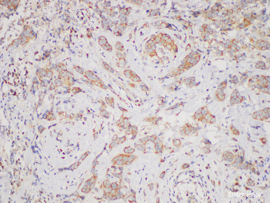 Immunohistochemistry of paraffin-embedded Human breast cancer using BCR Polycloanl Antibody at dilution of 1:200