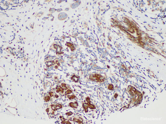 Immunohistochemistry of paraffin-embedded Human breast cancer using S100B Polycloanl Antibody at dilution of 1:50
