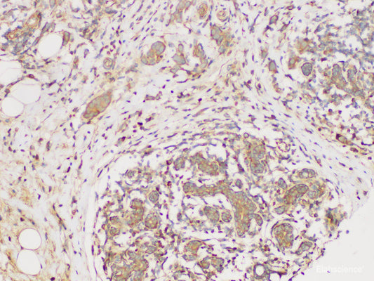 Immunohistochemistry of paraffin-embedded Human breast cancer using ECM1 Polycloanl Antibody at dilution of 1:300