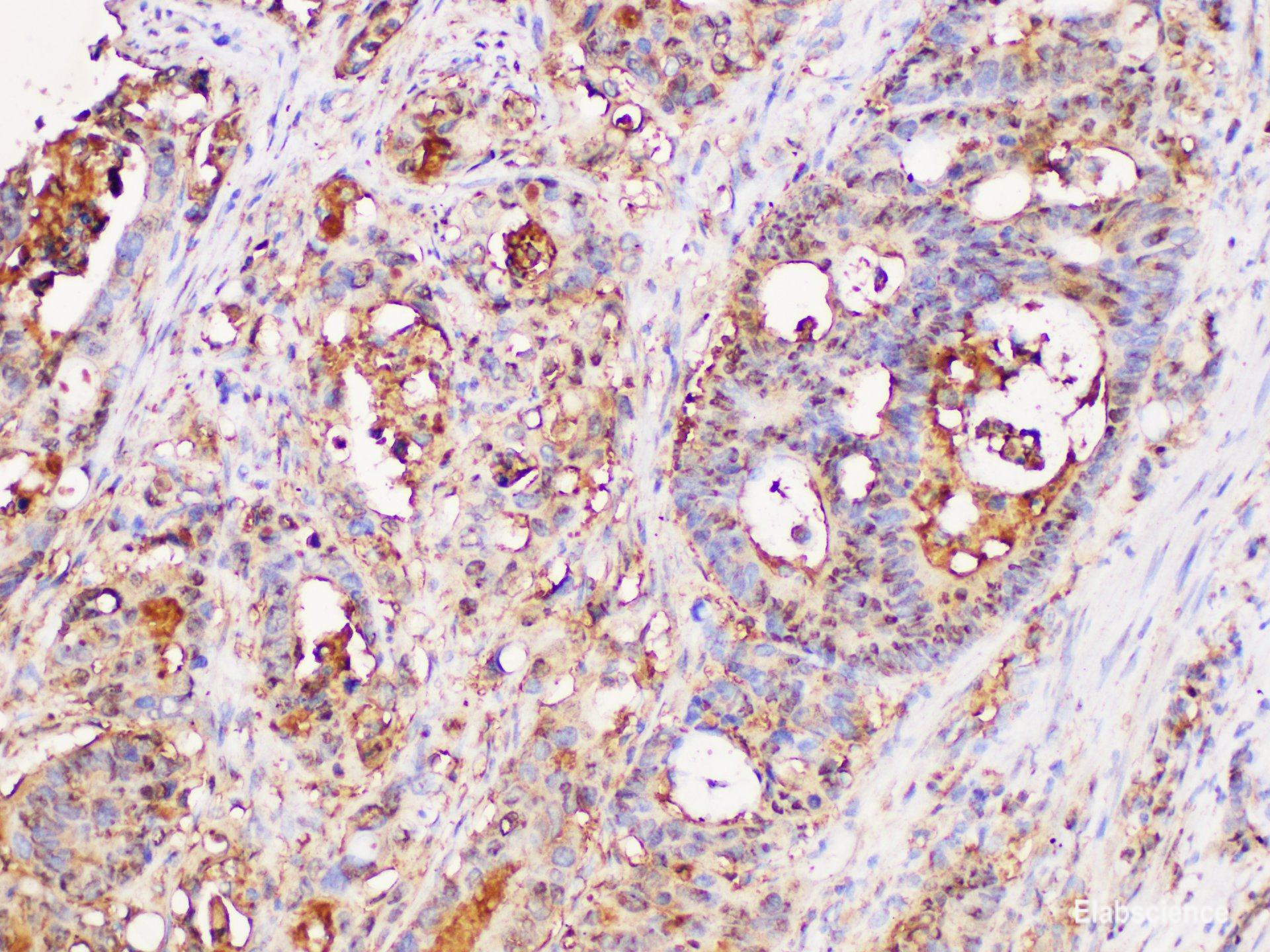 Immunohistochemistry of paraffin-embedded Human colon cancer using UBC Polycloanl Antibody at dilution of 1:100
