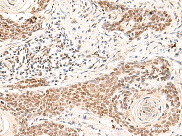 Immunohistochemistry of paraffin-embedded Human esophagus cancer tissue  using HOXD9 Polyclonal Antibody at dilution of 1:30(×200)