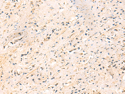 Immunohistochemistry of paraffin-embedded Human prost at e cancer tissue  using IP6K3 Polyclonal Antibody at dilution of 1:50(×200)
