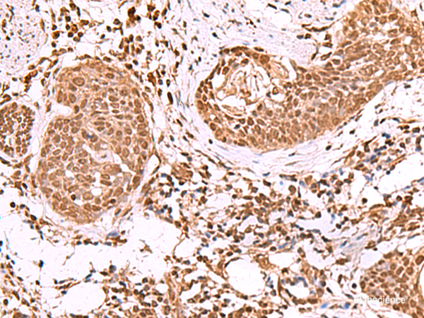 Immunohistochemistry of paraffin-embedded Human esophagus cancer tissue  using IP6K1 Polyclonal Antibody at dilution of 1:55(×200)