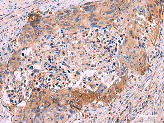 Immunohistochemistry of paraffin-embedded Human cervical cancer tissue  using GRIK4 Polyclonal Antibody at dilution of 1:50(×200)