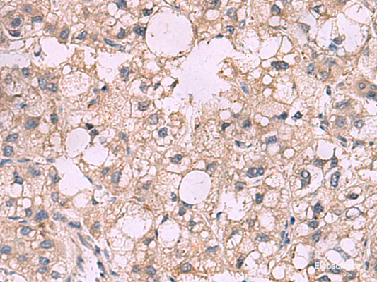 Immunohistochemistry of paraffin-embedded Human liver cancer tissue  using KCNIP1 Polyclonal Antibody at dilution of 1:40(×200)