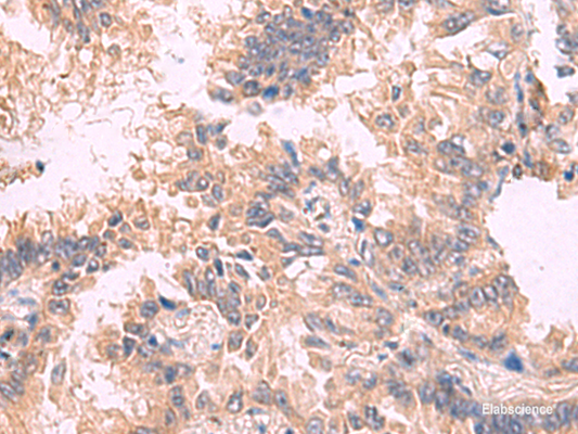 Immunohistochemistry of paraffin-embedded Human lung cancer tissue  using TJP1 Polyclonal Antibody at dilution of 1:30(×200)