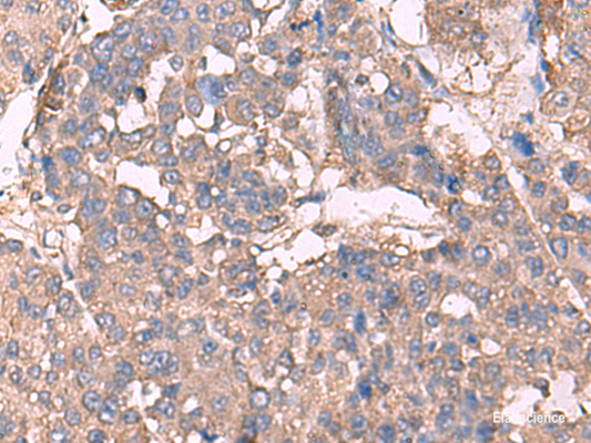 Immunohistochemistry of paraffin-embedded Human liver cancer tissue  using KCNN2 Polyclonal Antibody at dilution of 1:30(×200)