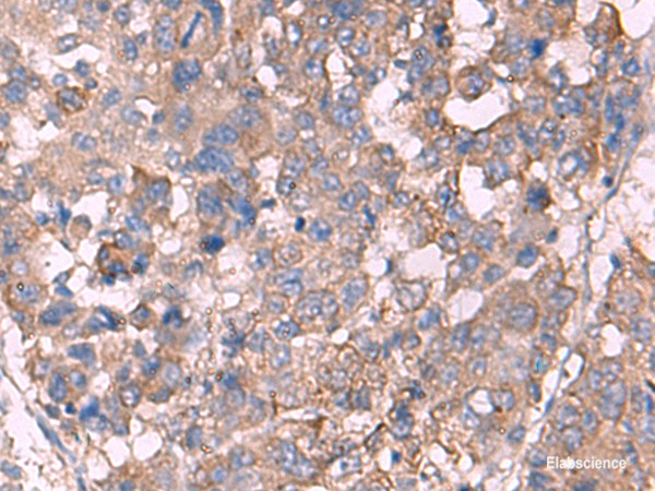 Immunohistochemistry of paraffin-embedded Human liver cancer tissue  using KCNN3 Polyclonal Antibody at dilution of 1:60(×200)