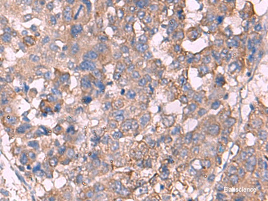 Immunohistochemistry of paraffin-embedded Human liver cancer tissue  using KCNN3 Polyclonal Antibody at dilution of 1:60(×200)