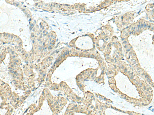Immunohistochemistry of paraffin-embedded Human thyroid cancer tissue  using CD9 Polyclonal Antibody at dilution of 1:40(×200)