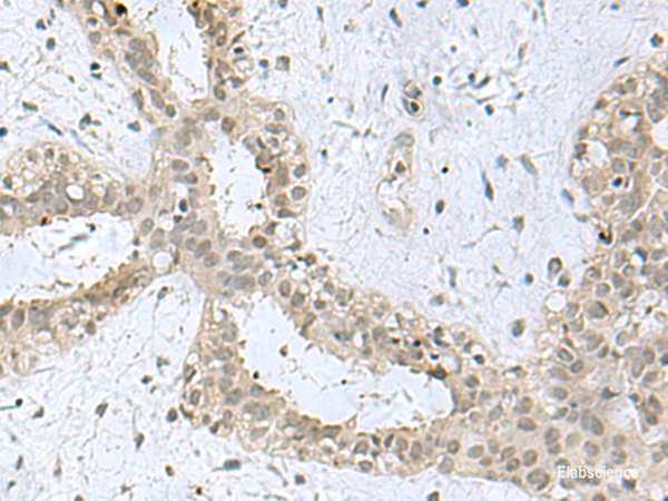 Immunohistochemistry of paraffin-embedded Human breast cancer tissue  using KDM3B Polyclonal Antibody at dilution of 1:40(×200)
