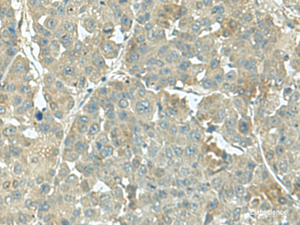 Immunohistochemistry of paraffin-embedded Human liver cancer tissue  using KRT36 Polyclonal Antibody at dilution of 1:55(×200)