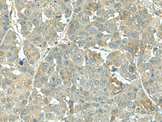 Immunohistochemistry of paraffin-embedded Human liver cancer tissue  using KRT36 Polyclonal Antibody at dilution of 1:55(×200)