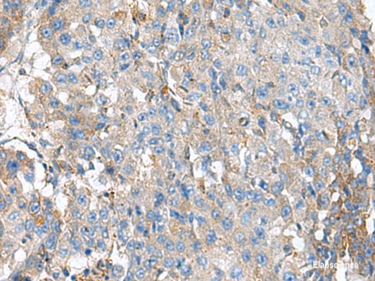 Immunohistochemistry of paraffin-embedded Human liver cancer tissue  using KIAA0556 Polyclonal Antibody at dilution of 1:90(×200)