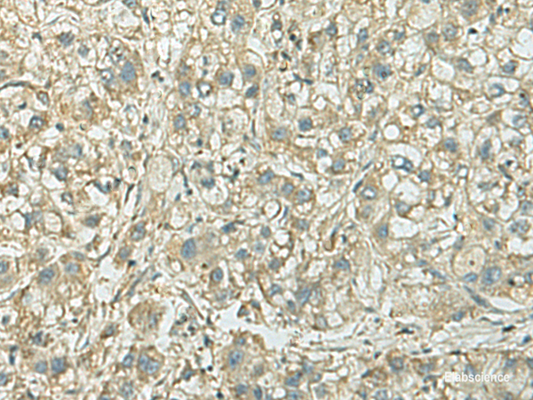 Immunohistochemistry of paraffin-embedded Human liver cancer tissue  using KIF21B Polyclonal Antibody at dilution of 1:40(×200)