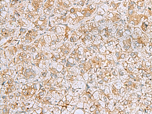 Immunohistochemistry of paraffin-embedded Human liver cancer tissue  using FERMT1 Polyclonal Antibody at dilution of 1:30(×200)