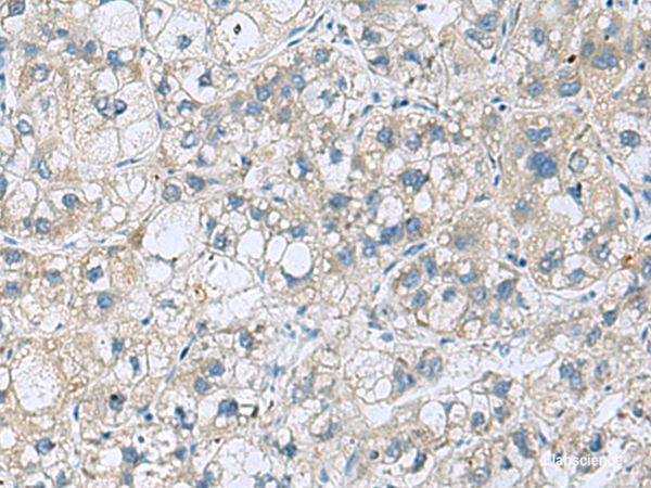 Immunohistochemistry of paraffin-embedded Human liver cancer tissue  using KCNJ2 Polyclonal Antibody at dilution of 1:35(×200)