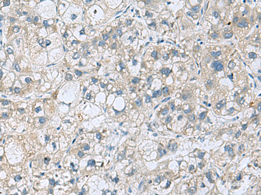Immunohistochemistry of paraffin-embedded Human liver cancer tissue  using KCNJ2 Polyclonal Antibody at dilution of 1:35(×200)
