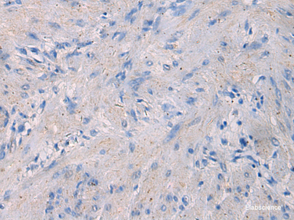 Immunohistochemistry of paraffin-embedded Human gastric cancer tissue  using NFKB1 Polyclonal Antibody at dilution of 1:80(×200)