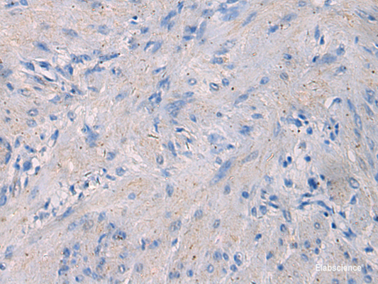 Immunohistochemistry of paraffin-embedded Human gastric cancer tissue  using NFKB1 Polyclonal Antibody at dilution of 1:80(×200)