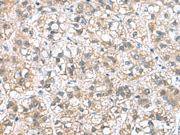 Immunohistochemistry of paraffin-embedded Human liver cancer tissue  using NFKB1 Polyclonal Antibody at dilution of 1:50(×200)
