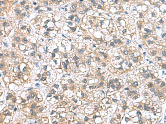 Immunohistochemistry of paraffin-embedded Human liver cancer tissue  using NFKB1 Polyclonal Antibody at dilution of 1:50(×200)