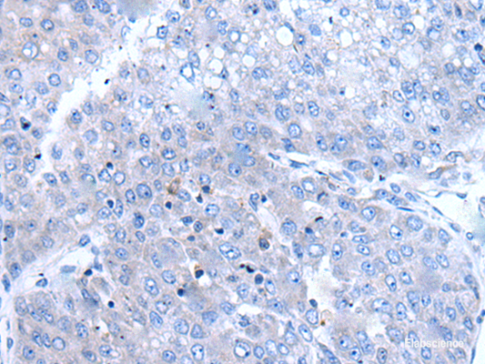 Immunohistochemistry of paraffin-embedded Human liver cancer tissue  using BTG4 Polyclonal Antibody at dilution of 1:65(×200)