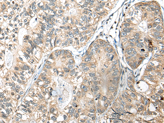Immunohistochemistry of paraffin-embedded Human gastric cancer tissue  using SLAMF7 Polyclonal Antibody at dilution of 1:30(×200)