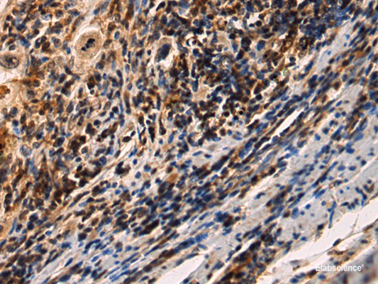 Immunohistochemistry of paraffin-embedded Human esophagus cancer tissue  using IRAK2 Polyclonal Antibody at dilution of 1:60(×200)
