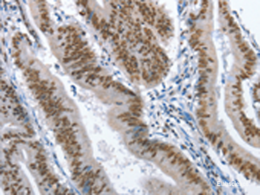 Immunohistochemistry of paraffin-embedded Human colon cancer tissue  using GNRH1 Polyclonal Antibody at dilution of 1:70(×200)