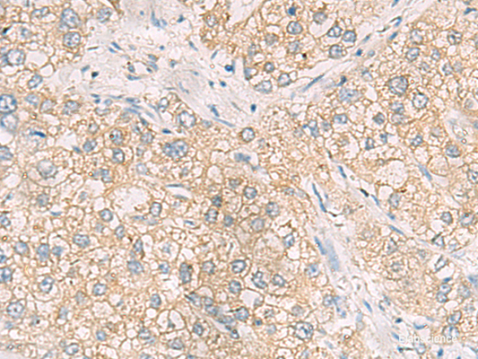 Immunohistochemistry of paraffin-embedded Human liver cancer tissue  using MAPK14 Polyclonal Antibody at dilution of 1:70(×200)