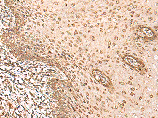Immunohistochemistry of paraffin-embedded Human esophagus cancer tissue  using BAP1 Polyclonal Antibody at dilution of 1:35(×200)
