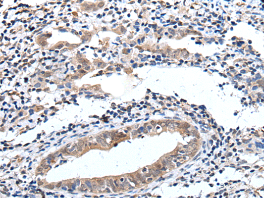 Immunohistochemistry of paraffin-embedded Human cervical cancer tissue  using ELMO1 Polyclonal Antibody at dilution of 1:40(×200)
