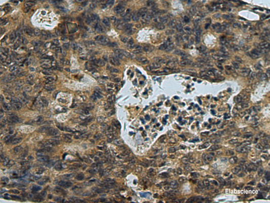 Immunohistochemistry of paraffin-embedded Human colorectal cancer tissue  using PLTP Polyclonal Antibody at dilution of 1:60(×200)