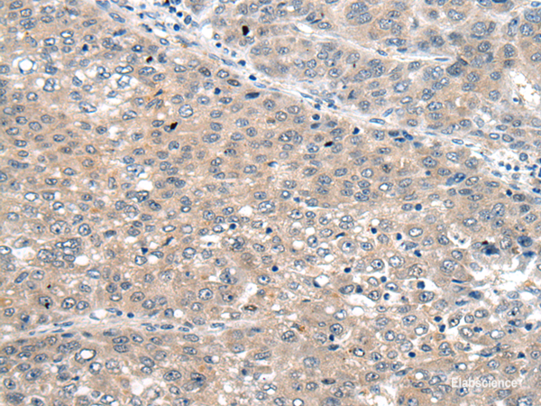 Immunohistochemistry of paraffin-embedded Human liver cancer tissue  using SEMA4D Polyclonal Antibody at dilution of 1:60(×200)